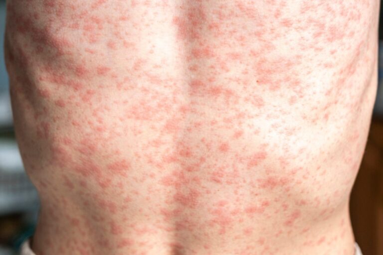 Tourist may have exposed ‘hundreds of thousands’ of people in San Antonio to measles, health experts say – KSAT