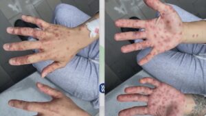Monkeypox case count grows to 5 in San Antonio as education process begins – WOAI