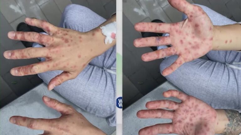 Monkeypox case count grows to 5 in San Antonio as education process begins – WOAI