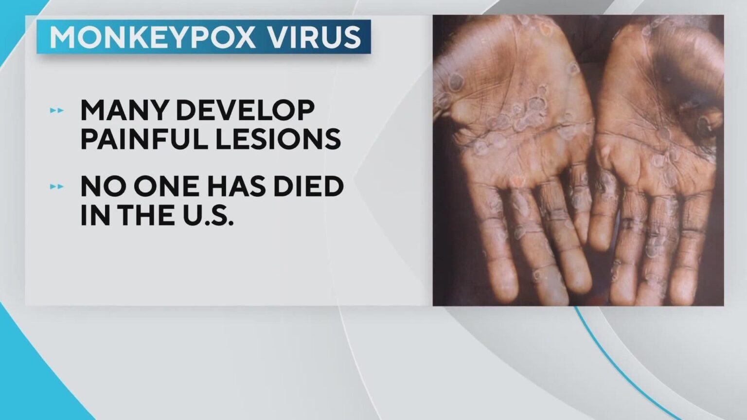 Monkeypox case count grows to 5 in San Antonio as education process begins – KABB